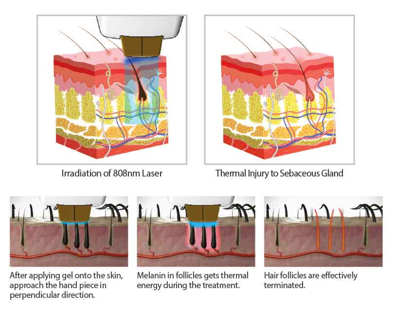 HR808半導(dǎo)體激光脫毛儀器價格（圖）_2