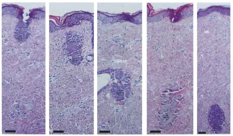 黃金微針超聲刀二合一Ultrasking儀器價(jià)格（圖）_8