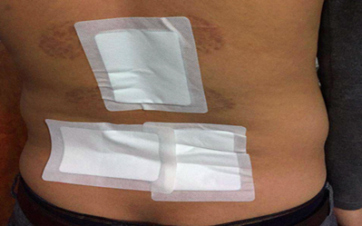 腰椎間盤突出的改善方法怎樣才能根治_3