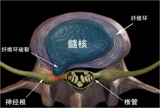 腰椎間盤突出用王九正能治好嗎_1