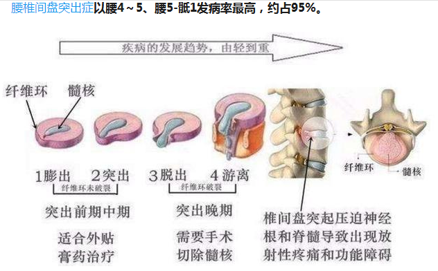 腰间盘突出怎么治图片