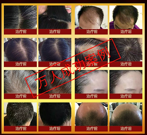 讓愛“發(fā)”生，百蓮凱“3、13首屆世界生發(fā)節(jié)”隆重開啟，備受全球脫發(fā)人群矚目（圖）_8