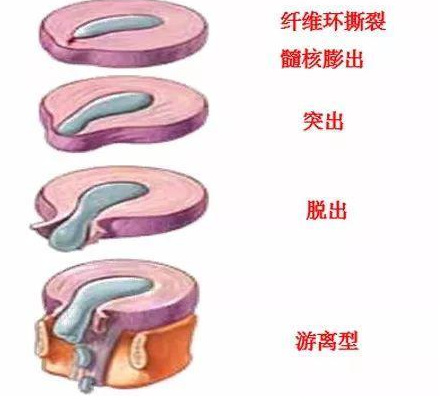 脱出:纤维环完全破裂,髓核组织通过破口突入椎管,部分在椎管内,部分尚