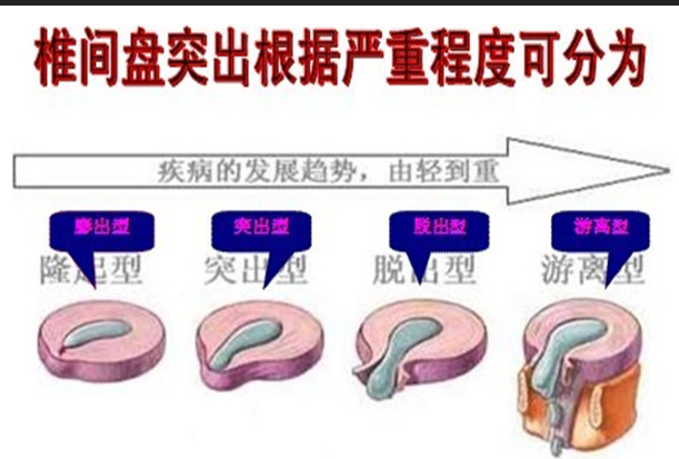 揭秘效果好的改善腰間盤突出的方法是不是王九正？_1