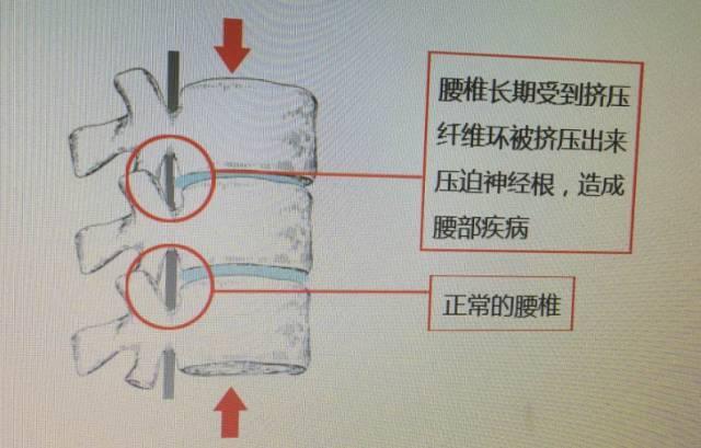 膏药排行榜第一的王九正贴能治愈腰椎病吗_1