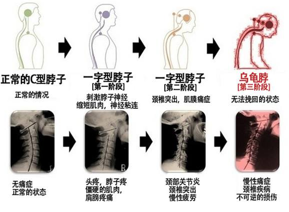 颈椎退变了颈椎病该怎么改善好？（图）_2