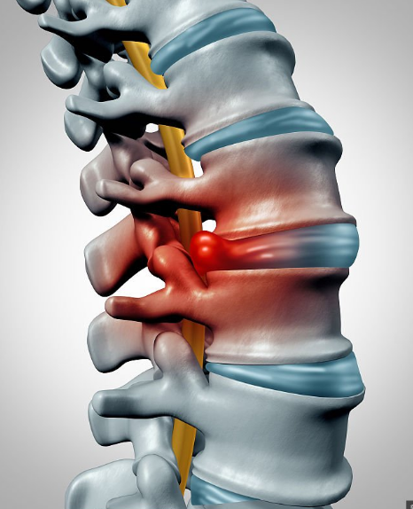 带你了解腰间盘突出症治好不是没有方法（图）_2