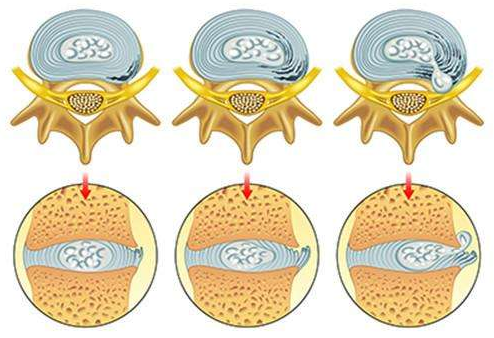 腰間盤突出癥用那種方法可以治好我告訴你?。▓D）_2