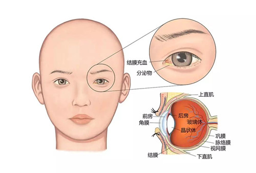 关于“过敏性结膜炎”，你必须要知道的常识！（图）_1