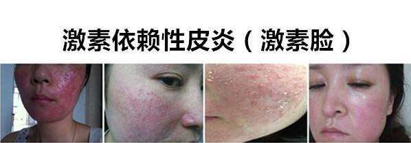 激素性皮炎怎么根治？氧趣臭氧膏改善激素性皮炎怎么樣？（圖）_1