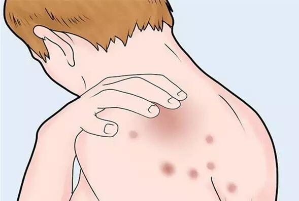 氧趣臭氧膏改善成人濕疹效果如何？（圖）_3