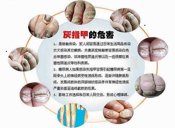 氧趣臭氧膏为什么可以治愈灰指甲？（图）_1